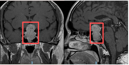 华锋优配网 不明原因视力下降、突然“发福”，可能是长了这种脑瘤！